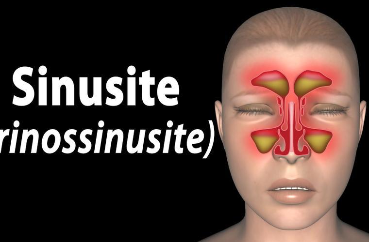 Sinusite : définition, causes et traitements